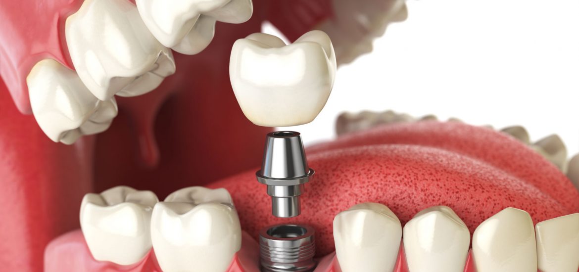 Dental-Implants-The-Future-is-Here-1170x550.jpg